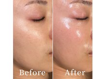 ユカリス(Yu.charis)の雰囲気（【ミコステラ】無針水光注入で渡韓せずに憧れの韓国美肌へ♪）