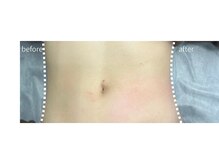 リフト 門前仲町(Lift)/小顔専門店Lift｜Before After