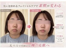 トータルヘルスビューティーカズ(TotalHealthBeauty KAZU)/【肌質改善】光の森/光美容