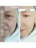 【ハーブピーリング】たるみケア<フレッシュアップカウンセリング¥0