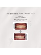 プラスビーセルフ(+b self)/ホワイトニングビフォーアフター