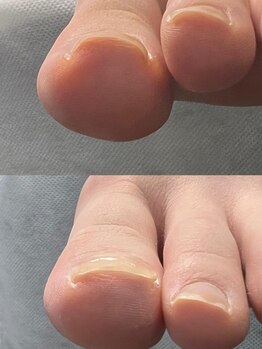 本山整体サロンの写真/【巻き爪でお悩みの方におススメ!!】足や爪のトラブル解消!!靴が履きにくい,歩くのが辛い等の悩みを解決★