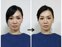 エイジングハルハル/ホウレイ線改善、たるみ改善