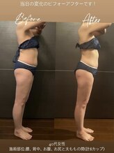 フェリシア(FELICIA)/脂肪冷却当日ビフォーアフター