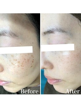 パールホワイトニングサロン 小田原店/小さいシミ改善