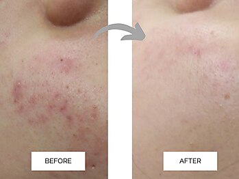 リンネ(Rin'ne)/プラズマ光フェイシャル