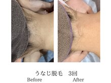 ミーシェ(Meshie)/襟足脱毛　施術前後
