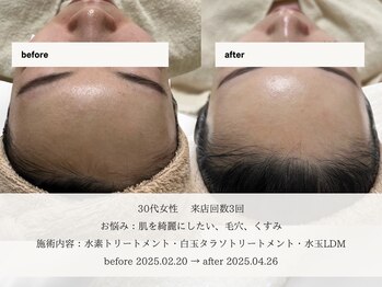 エメ 名古屋栄店(aimer)/SkinCare <肌管理・エイジング>
