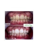 ホワイトニングサロン 名古屋駅店/【ホワイトニング施術例】