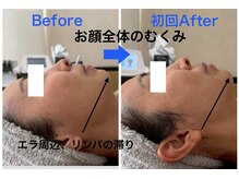 インフィニティ セルラム(INFINITY CELLULAM)/ビフォーアフター