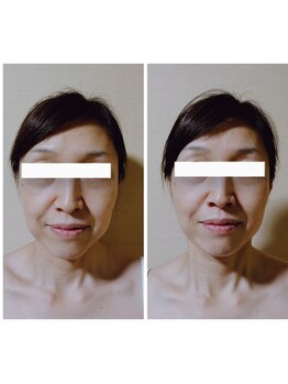 キュアボディ(Cure Body)/美容鍼/小顔効果・リフトアップ