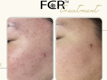 ワイキューマルサン(y903)/【FCRハーブピーリング】