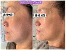 プリュネル(Prunelle)/プラズマシャワー