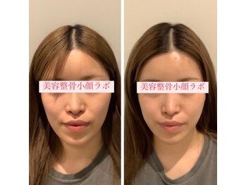 美容整骨小顔ラボ/新技術リフトアップマシン
