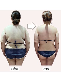 じぶんdeエステ 梅田店/-20kg達成!後ろからのビフォアフ