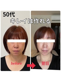 顔凛(カオリン)/50代女性の小顔矯正
