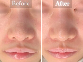 ボーンオム(Born Homme)/毛穴洗浄＋美容液導入：30代女性