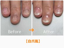 レアム/爪のコンプレックス解消したい！