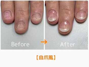 レアム/爪のコンプレックス解消したい！