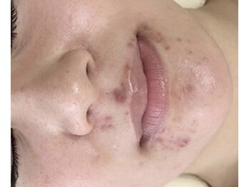 リベル 名古屋(Lebelle:)/ハーブピーリング　名古屋　栄