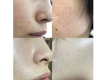 ニコラフ(Nico laugh)の雰囲気（剥離なしハーブピーリング2回目before after ）