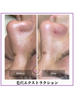 ラナン パラフューズ(Ranun's PARAFUSE.)/毛穴ビフォーアフター(4)