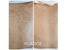 プランス 熊本(PLANCE)の雰囲気（背中の肌荒れもスピード改善！）