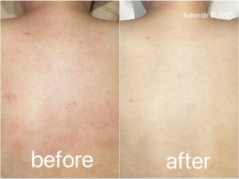 サロン ド ブラン アオヤマ(Salon de BLANC AOYAMA)/ハーブピーリングで背中ケア