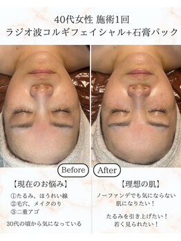 シーフェイス 横浜店(SEE FACE)/ラジオ波小顔コルギ+石膏パック