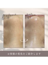 ルルーディア(LOULOUDIA)/毛穴洗浄ピーリング！