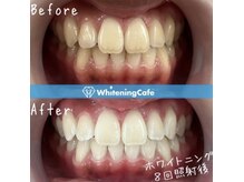 ホワイトニングカフェ 豊中店(WhiteningCafe)の雰囲気（ホワイトニング症例♪当店の症例は加工等一切しておりません☆）