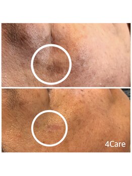 フォーケア(4Care)/ホワイトラボ