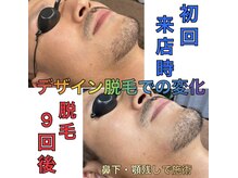 ホーミーズ 燕三条(HOMIES)/デザイン脱毛9回の変化
