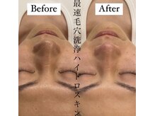 エイティ(Atey)/メンズハイドロ