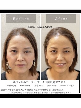 サロン ルイス アディクト(salon Lewis Addict)/一回で終わらせたい■VIPコース