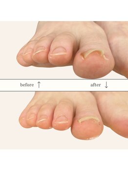 本沢整骨院/巻き爪矯正Before/After