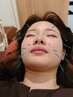 【会員価格】美容鍼灸premium