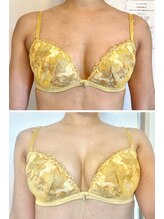 美人バスト 小倉店/バストアップ◇症例◇