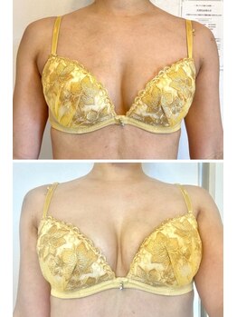 美人バスト 小倉店/バストアップ◇症例◇