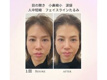ナナイロ(nanairo)の雰囲気（右顔面ヒト幹細胞、左顔面エクソソームマイクロニードル使用）