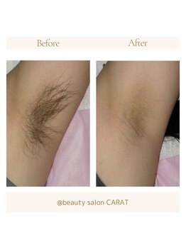 カラット(CARAT)/レディース脇脱毛