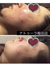 ナトゥーラ チュチュ(natura chuchu)/ビフォーアフター