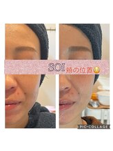 ソイ(soi)/光フェイシャル