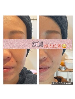 ソイ(soi)/光フェイシャル