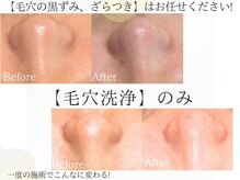 くすくすの雰囲気（一度の施術でこれだけ変わる!【毛穴洗浄】おススメです★）