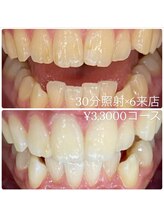 ホワイトニングルーム 横浜店(Whitening Room)/ホワイトニング/横浜