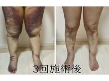 術後インディバ専門サロン 新宿/太もも吸引/術後インディバケア