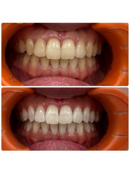 コナホワイトニング 神保町/セルフホワイトニング神保町