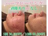 【お得な回数券】剥離ありorなし選べるハーブピーリング10回50,000円