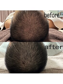 アキュセル ヨウコナース アンド 暢子美容鍼灸(Accu:Cell Youko nurse)/頭皮の鍼